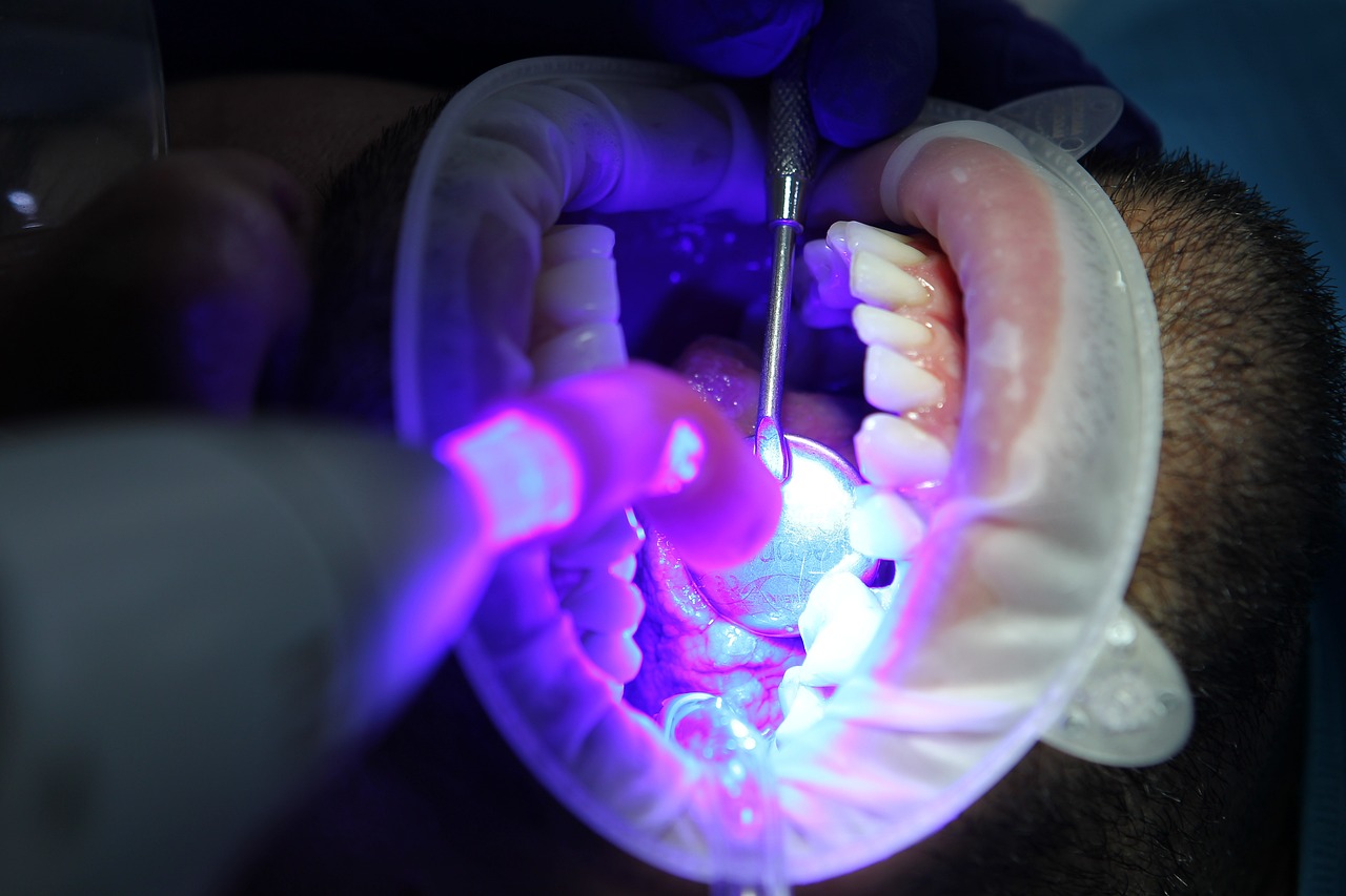 Common Teeth Whitening Mistakes